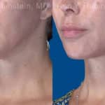 Face lift & Neck lift Before and After Photos in Newburgh, NY, Patient 20068