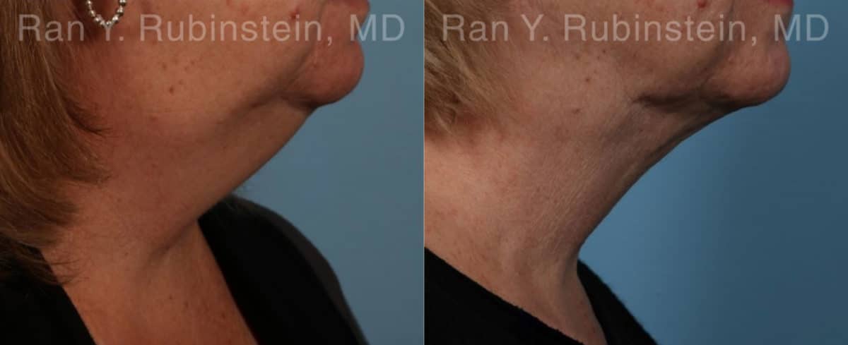 Laser Lift Precision Tx Before and After Photos in Newburgh, NY, Patient 20445