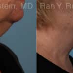 Laser Lift Precision Tx Before and After Photos in Newburgh, NY, Patient 20445