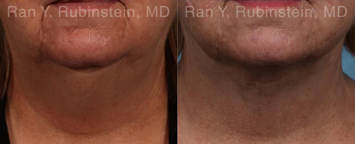 Laser Lift Precision Tx Before and After Photos in Newburgh, NY, Patient 20445