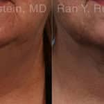 Laser Lift Precision Tx Before and After Photos in Newburgh, NY, Patient 20445