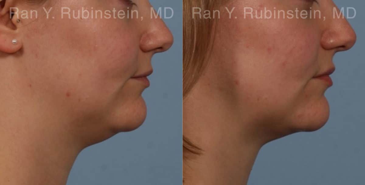 Laser Lift Precision Tx Before and After Photos in Newburgh, NY, Patient 20452