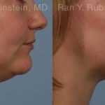 Laser Lift Precision Tx Before and After Photos in Newburgh, NY, Patient 20452