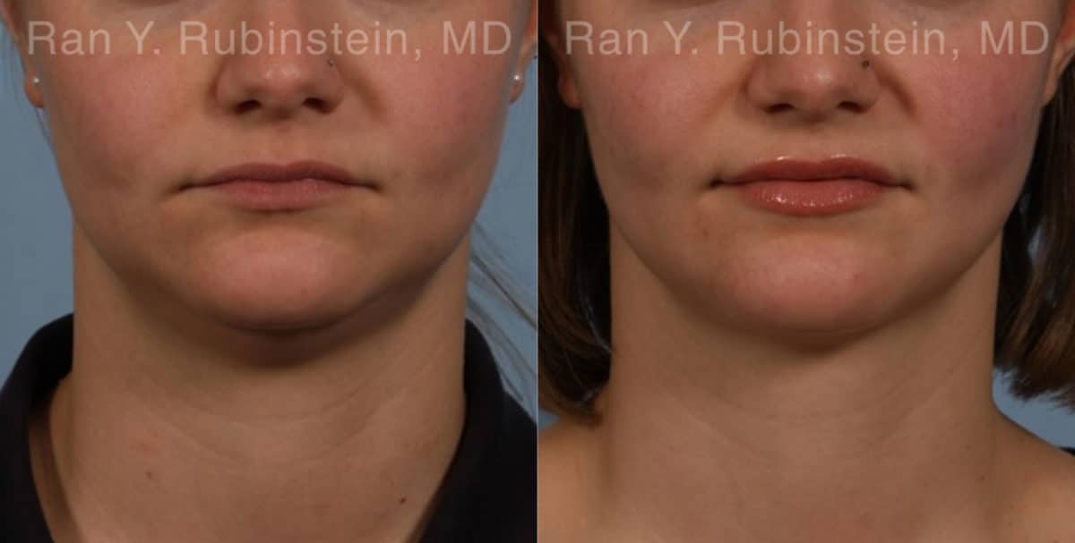 Laser Lift Precision Tx Before and After Photos in Newburgh, NY, Patient 20452