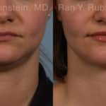 Laser Lift Precision Tx Before and After Photos in Newburgh, NY, Patient 20452