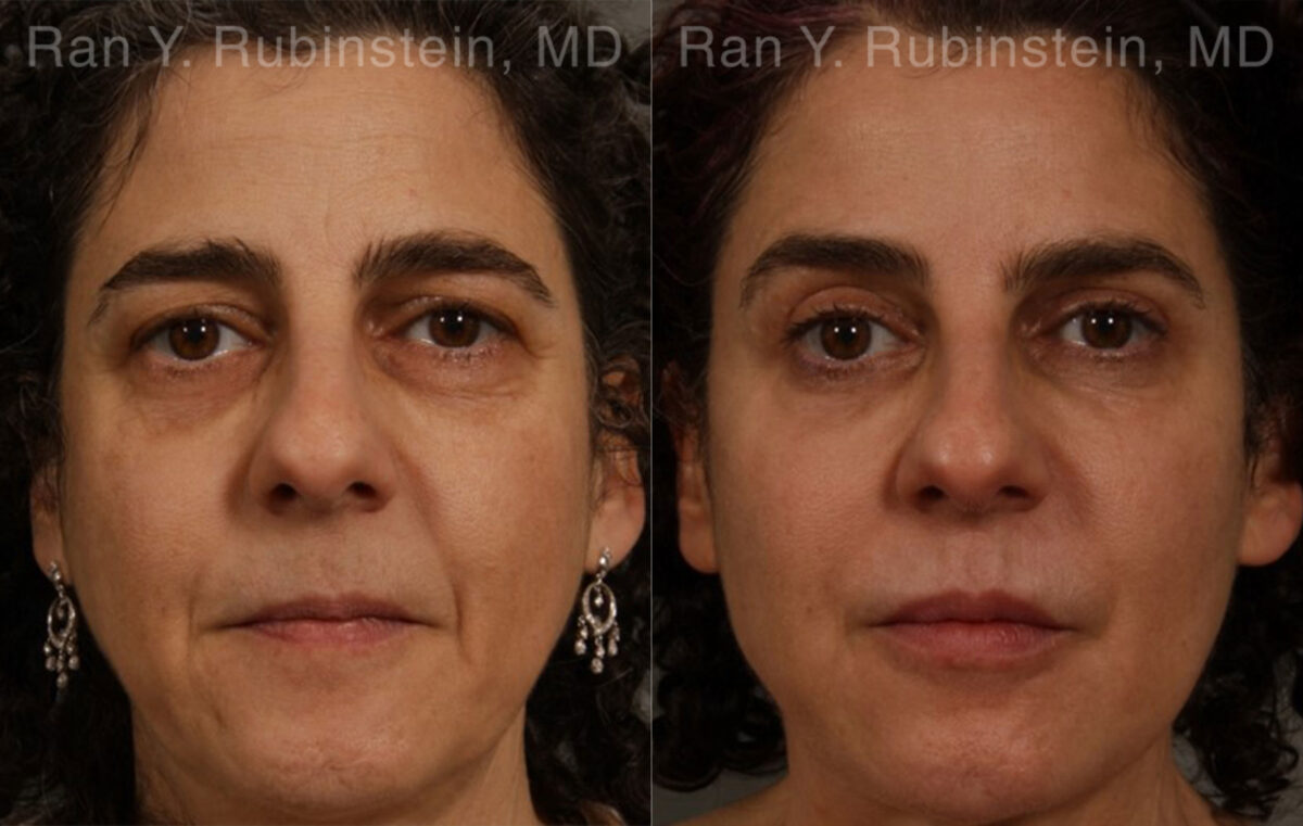 Eyelid Surgery Before and After Photos in Newburgh, NY, Patient 20475
