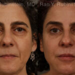 Eyelid Surgery Before and After Photos in Newburgh, NY, Patient 20475