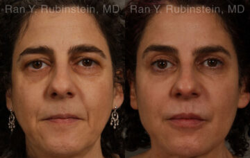 Eyelid Surgery Before and After Photos in Montvale, NJ, Patient 20475