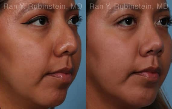 Ethnic Rhinoplasty Before and After Photos in Newburgh, NY, Patient 20479