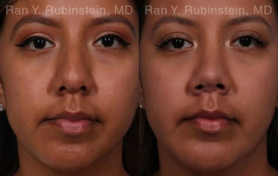 Ethnic Rhinoplasty Before and After Photos in Newburgh, NY, Patient 20479