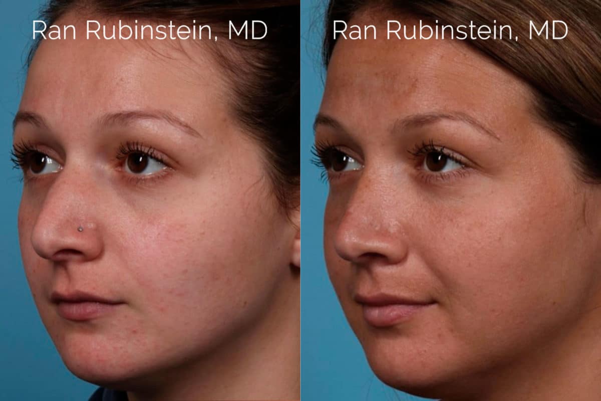 Rhinoplasty Before and After Photos in Newburgh, NY, Patient 20486