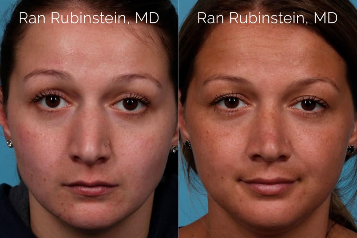 Rhinoplasty Before and After Photos in Newburgh, NY, Patient 20486