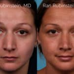 Rhinoplasty Before and After Photos in Newburgh, NY, Patient 20486