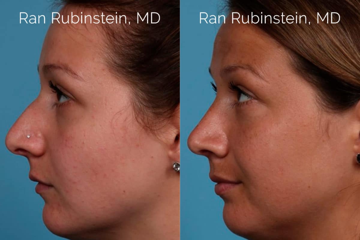 Rhinoplasty Before and After Photos in Newburgh, NY, Patient 20486