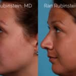 Rhinoplasty Before and After Photos in Newburgh, NY, Patient 20486