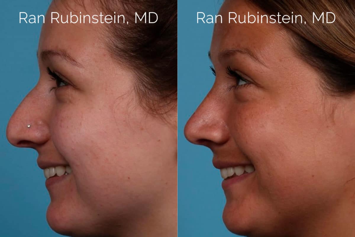 Rhinoplasty Before and After Photos in Newburgh, NY, Patient 20486