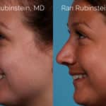 Rhinoplasty Before and After Photos in Newburgh, NY, Patient 20486