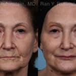 Dermal Fillers Before and After Photos in Newburgh, NY, Patient 20745