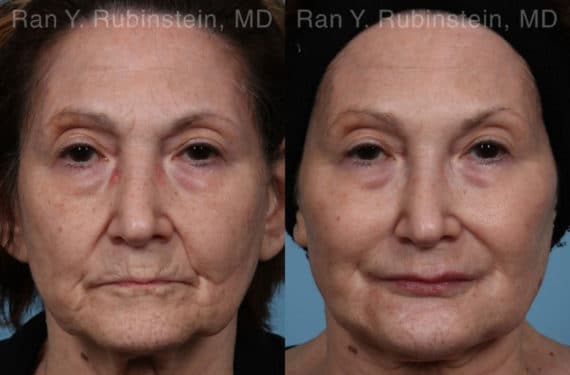 Dermal Fillers Before and After Photos in Newburgh, NY, Patient 20745