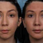 Chin Augmentation Before and After Photos in Newburgh, NY, Patient 20848