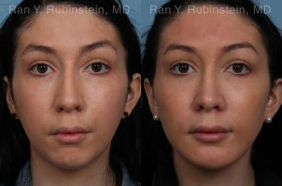 Chin Augmentation Before and After Photos in Newburgh, NY, Patient 20848