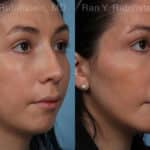 Chin Augmentation Before and After Photos in Newburgh, NY, Patient 20848