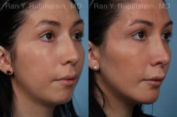 Chin Augmentation Before and After Photos in Newburgh, NY, Patient 20848