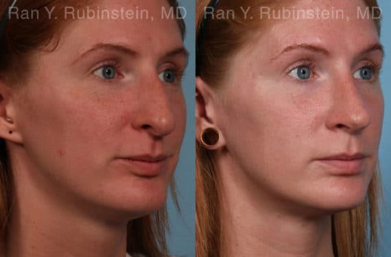 Rhinoplasty Before and After Photos in Newburgh, NY, Patient 21130