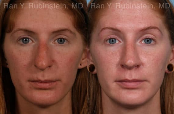 Rhinoplasty Before and After Photos in Newburgh, NY, Patient 21130