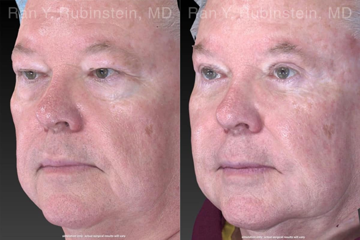 Eyelid Surgery Before and After Photos in Newburgh, NY, Patient 21152