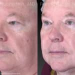 Eyelid Surgery Before and After Photos in Newburgh, NY, Patient 21152