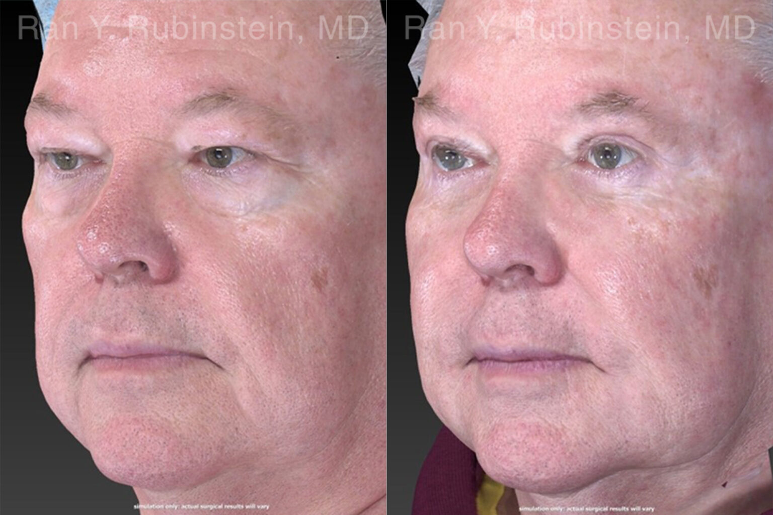 Eyelid Surgery Photos Newburgh, NY Patient 21152