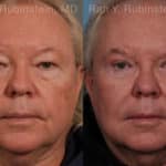 Eyelid Surgery Before and After Photos in Newburgh, NY, Patient 21152