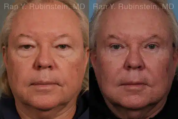 Eyelid Surgery Before and After Photos in Newburgh, NY, Patient 21152