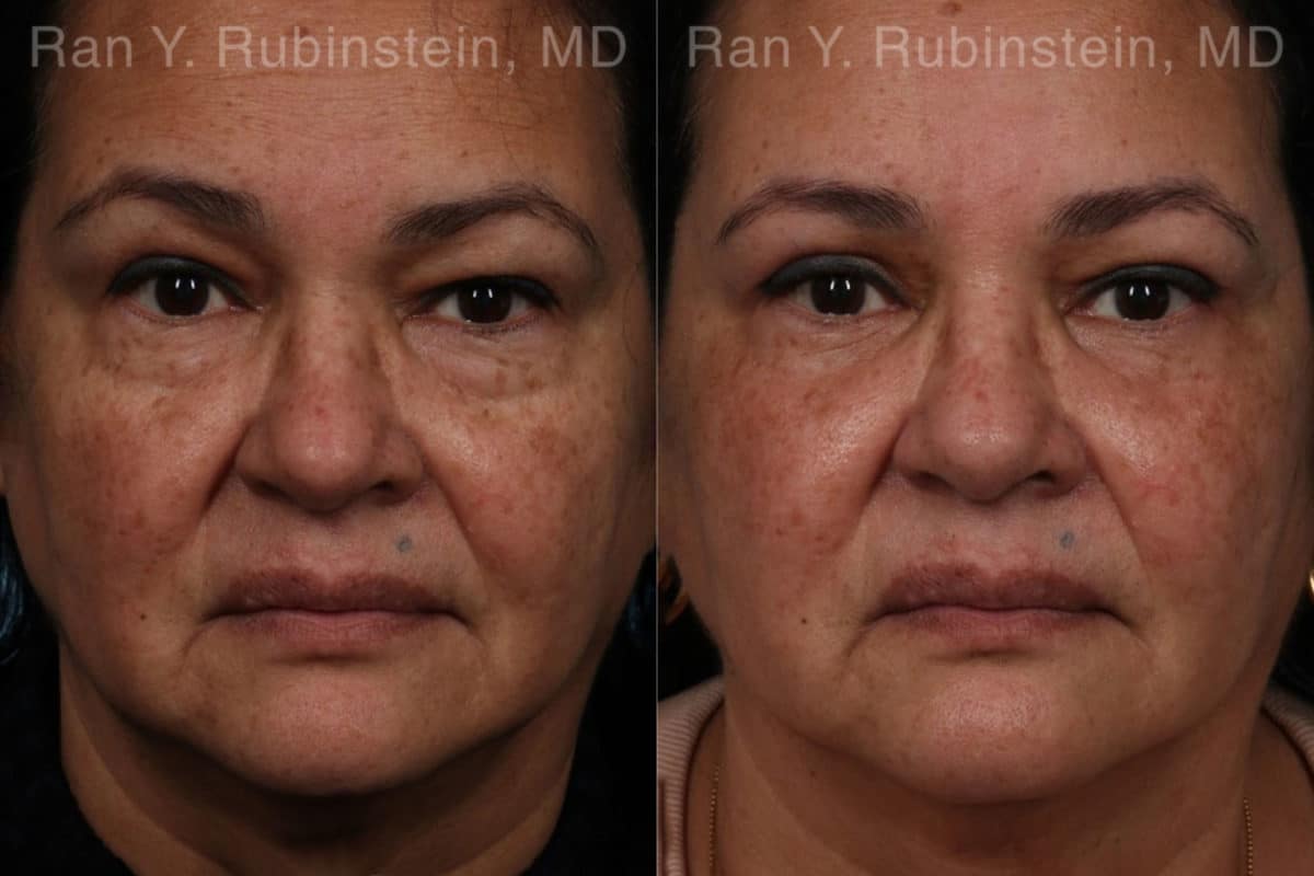 Eyelid Surgery Before and After Photos in Newburgh, NY, Patient 21159