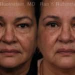 Eyelid Surgery Before and After Photos in Newburgh, NY, Patient 21159