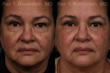 Eyelid Surgery Before and After Photos in Montvale, NJ, Patient 21159