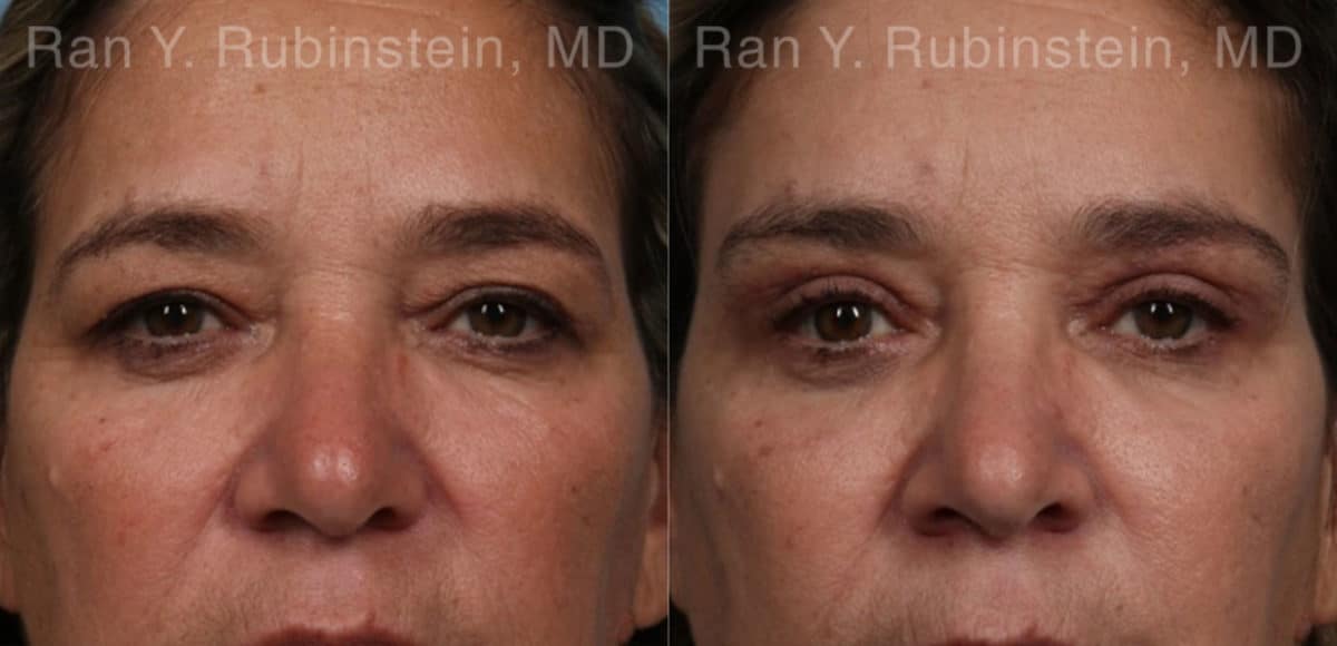 Brow Lift Before and After Photos in Newburgh, NY, Patient 21163