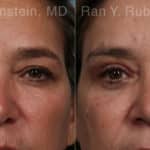 Brow Lift Before and After Photos in Newburgh, NY, Patient 21163