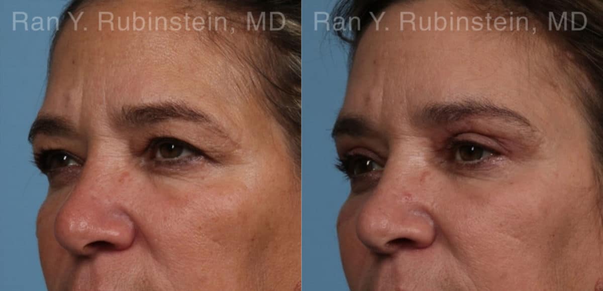 Brow Lift Before and After Photos in Newburgh, NY, Patient 21163