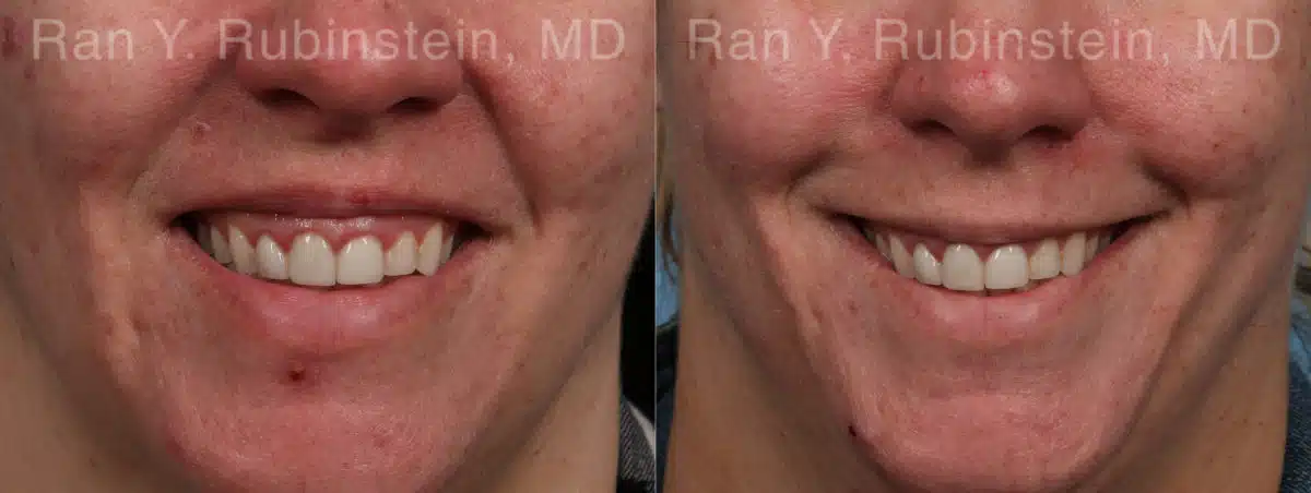 Botox Before and After Photos in Newburgh, NY, Patient 21747