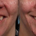 Botox Before and After Photos in Newburgh, NY, Patient 21747