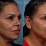 Laser Lift Precision Tx Before and After Photos in Newburgh, NY, Patient 21756