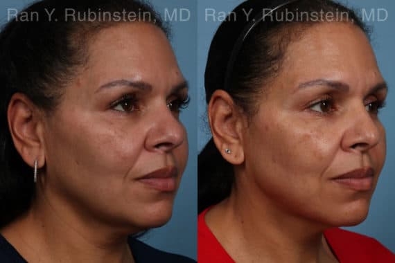 Laser Lift Precision Tx Before and After Photos in Newburgh, NY, Patient 21756