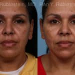 Laser Lift Precision Tx Before and After Photos in Newburgh, NY, Patient 21756