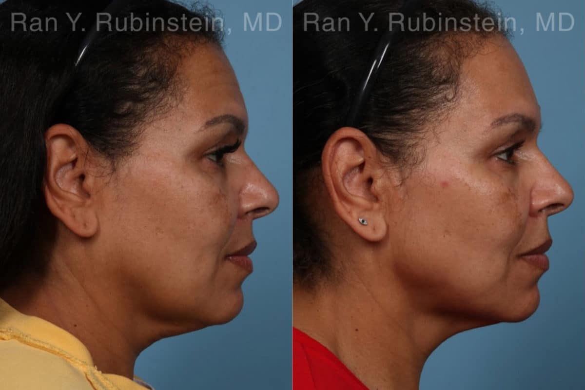 Laser Lift Precision Tx Before and After Photos in Newburgh, NY, Patient 21756