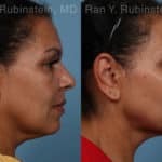 Laser Lift Precision Tx Before and After Photos in Newburgh, NY, Patient 21756