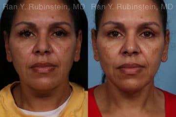 Laser Lift Precision Tx Before and After Photos in Newburgh, NY, Patient 21756