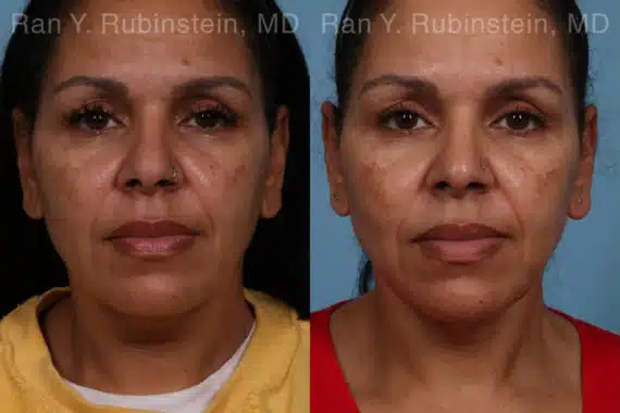 SKIN TIGHTENING BEFORE & AFTER PHOTOS