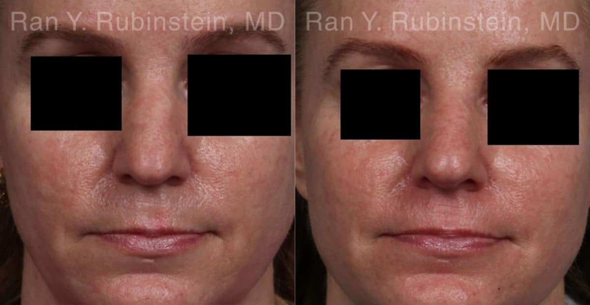 Non-Surgical Rhinoplasty Before and After Photos in Newburgh, NY, Patient 21776